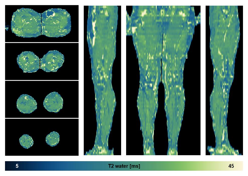 The water only T2 relaxation time of the lower extremity obtained from multi echo spin echo t2 mapping with EPG based reconstruction.